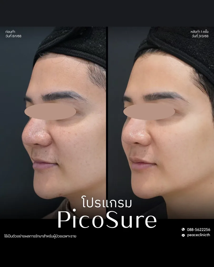 PicoSure · จุดด่างดำ — มุมเฉียง