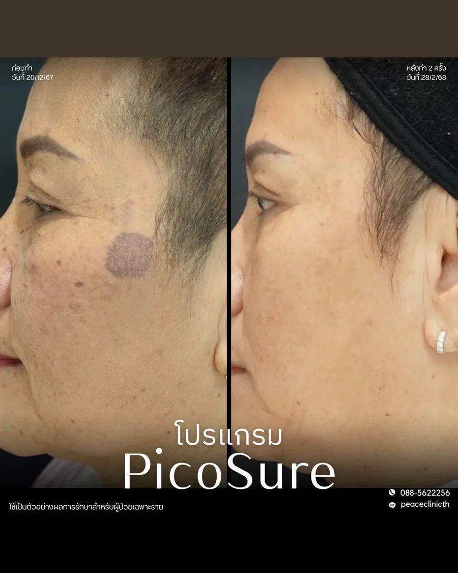 PicoSure · จุดด่างดำ — จุดด่างดำที่แก้ม · มุมเฉียง