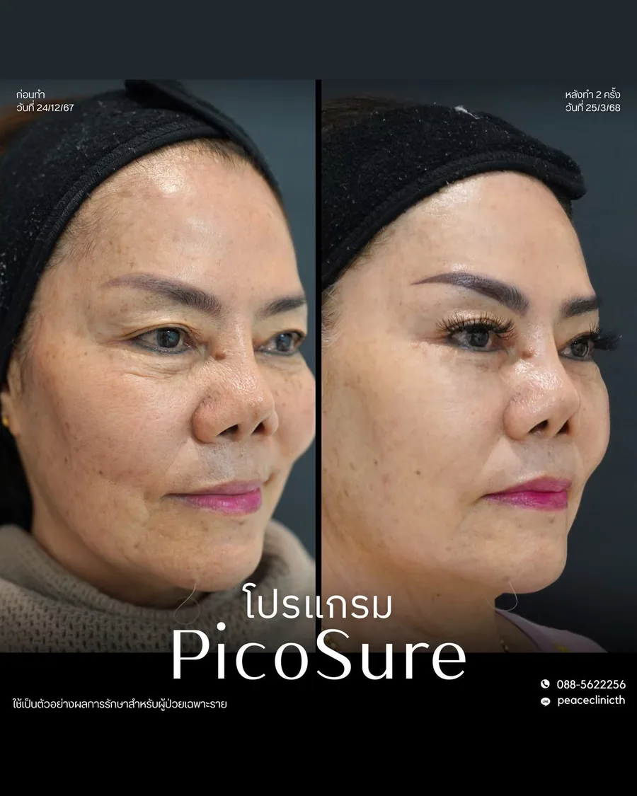 PicoSure · จุดด่างดำ — หน้าตรง