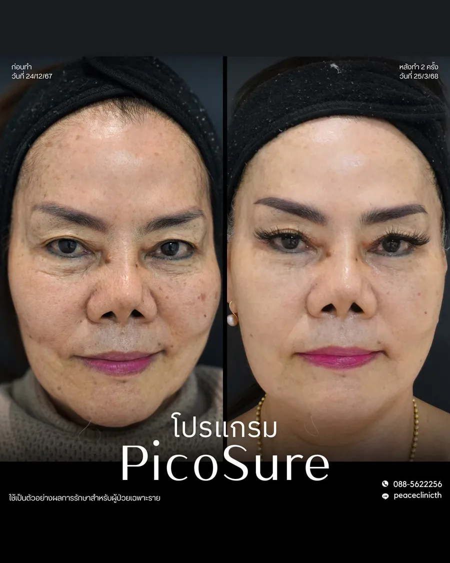 PicoSure · จุดด่างดำ — หน้าตรง