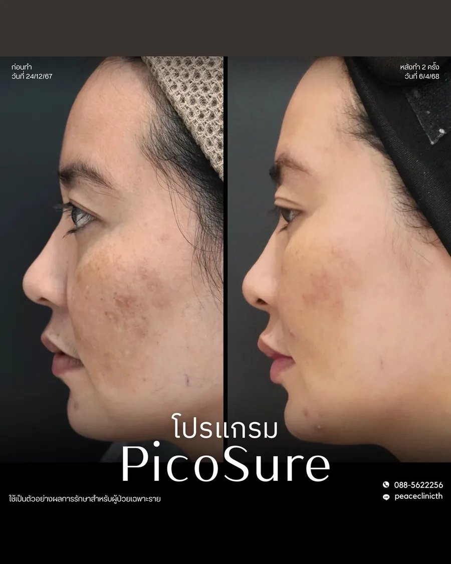 PicoSure · จุดด่างดำ — มุมด้านข้าง