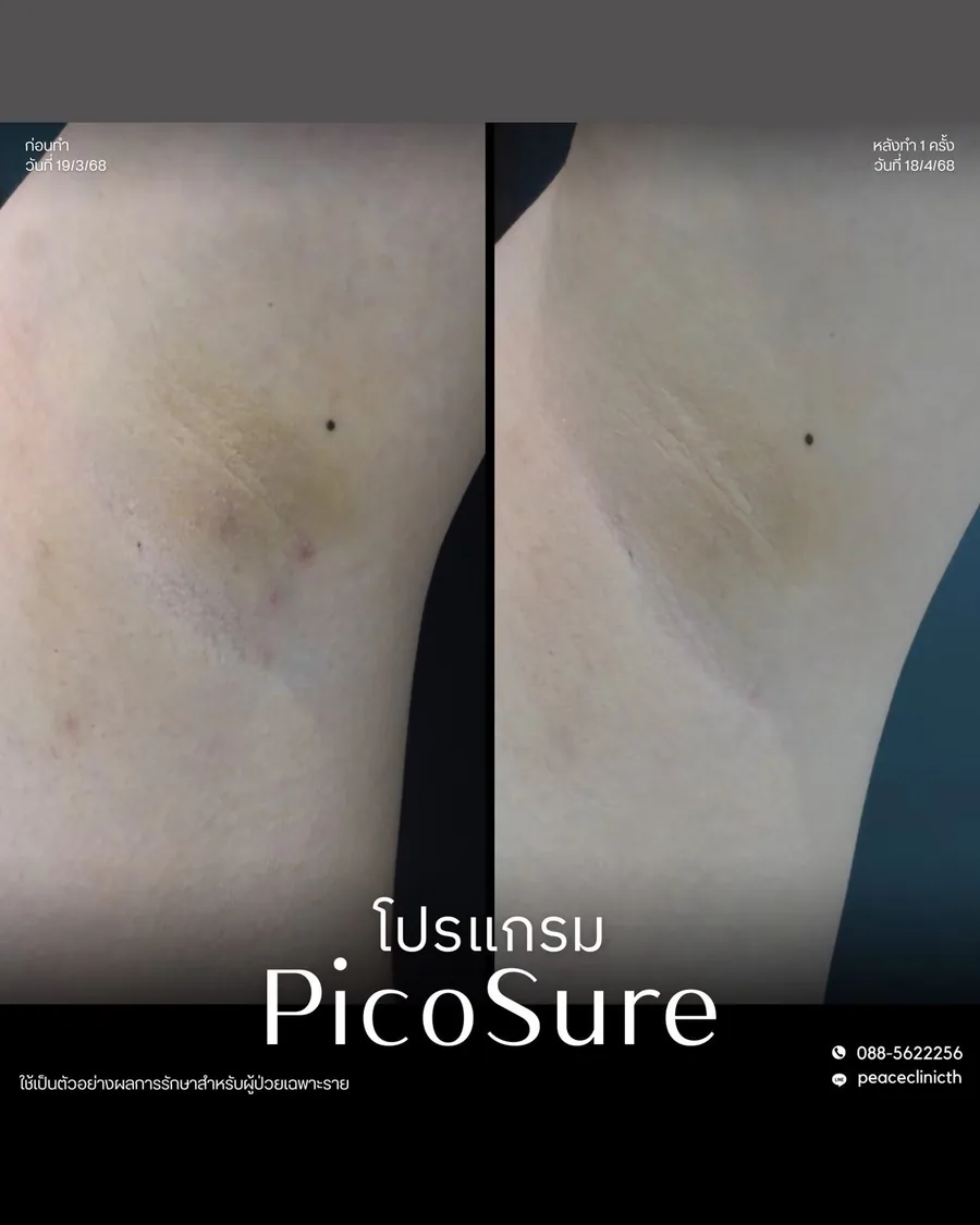 PicoSure · ผิวกาย — ใต้วงแขน