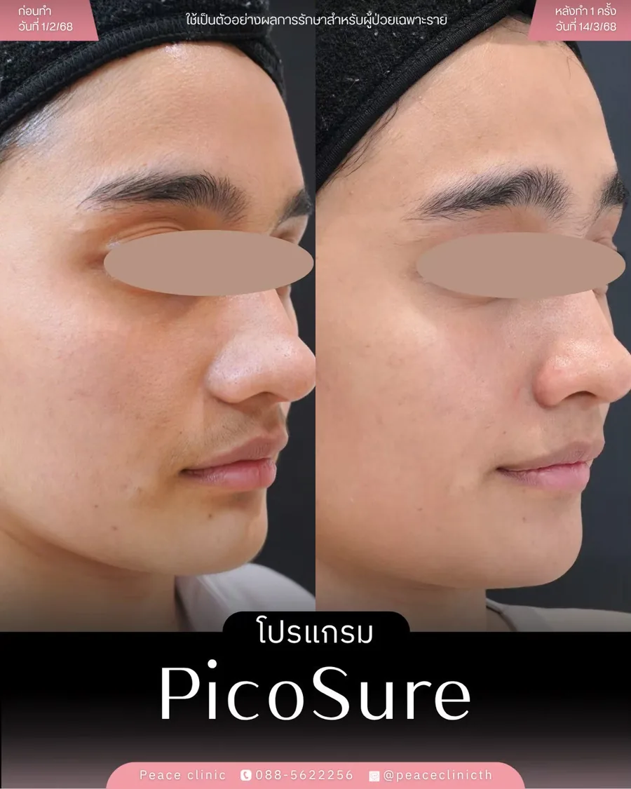 PicoSure · จุดด่างดำ — มุมเฉียง