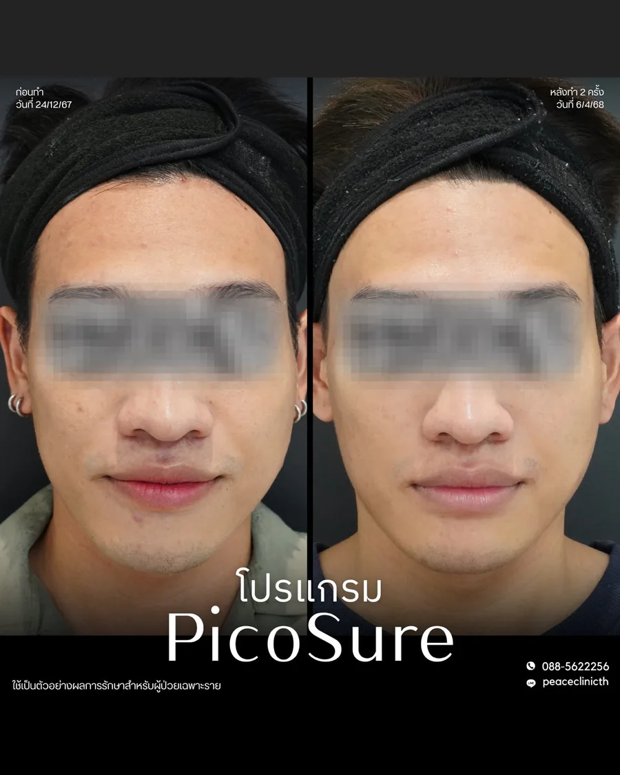 PicoSure · จุดด่างดำ — หน้าตรง