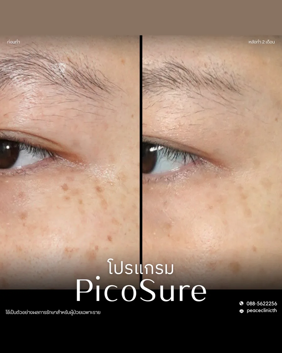 PicoSure · จุดด่างดำ — รอบดวงตาและขมับ
