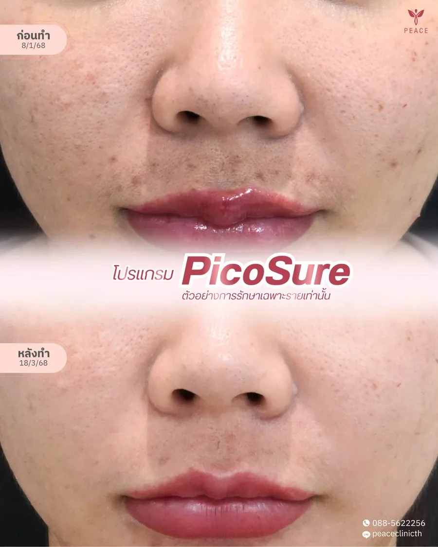 PicoSure · จุดด่างดำ — รอบปาก