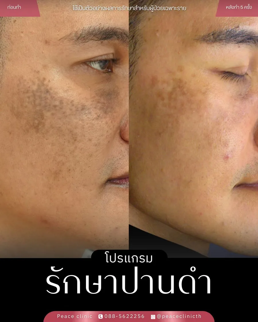 PicoSure · รักษาปานดำ — มุมเฉียง
