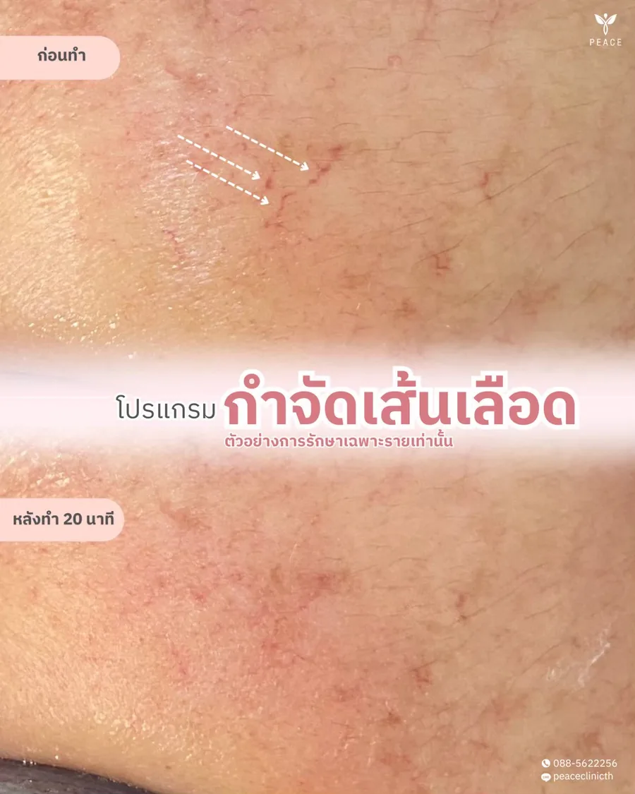 กำจัดเส้นเลือดฝอย — หลังทำ 20 นาที