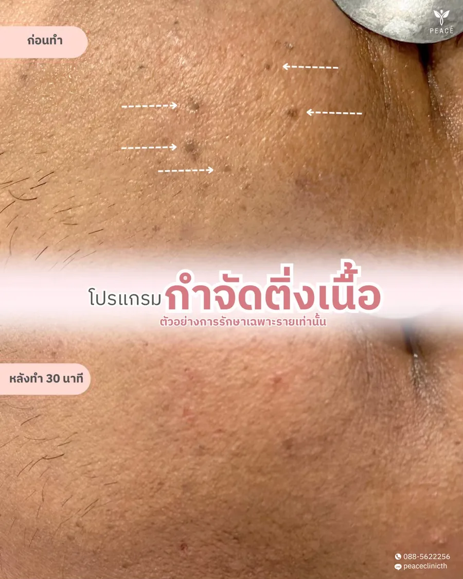 กำจัดติ่งเนื้อ — หลังทำ 30 นาที