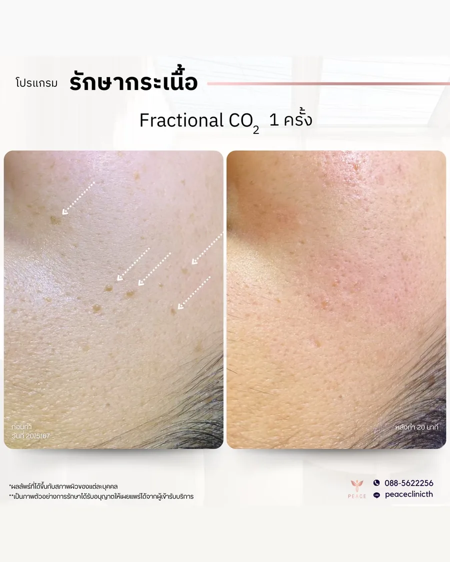 Fractional CO2 · หลุมสิว — หลังทำ 1 ครั้ง