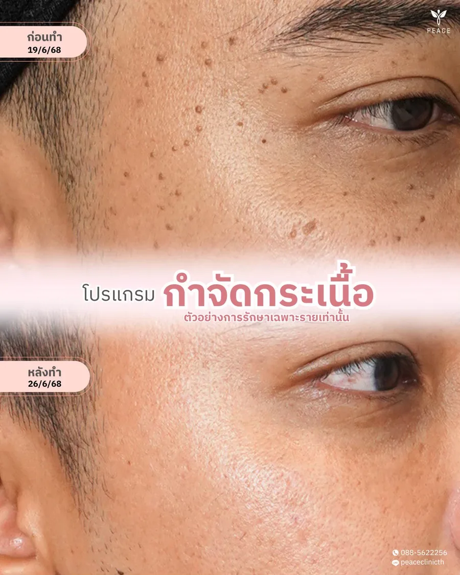 กำจัดกระเนื้อ — รอบดวงตา