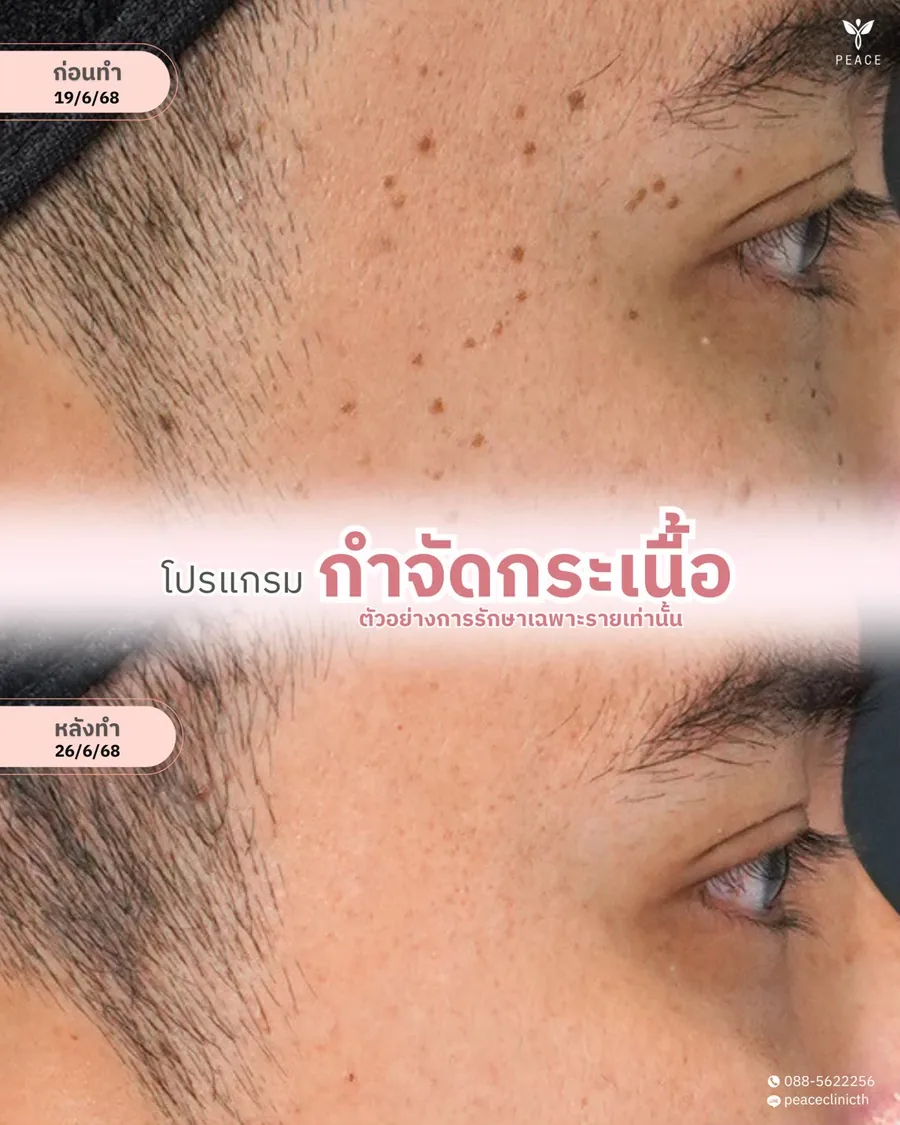 กำจัดกระเนื้อ — มุมเฉียง