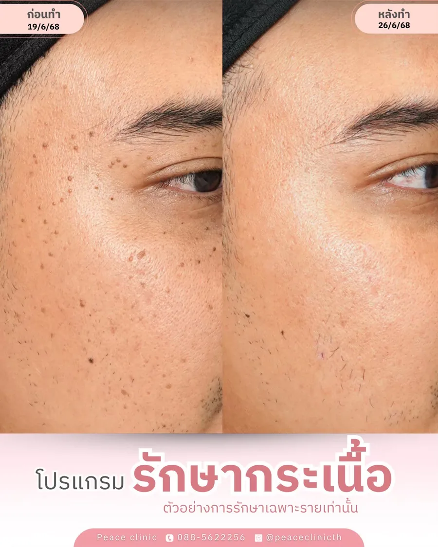 กำจัดกระเนื้อ — มุมเฉียง