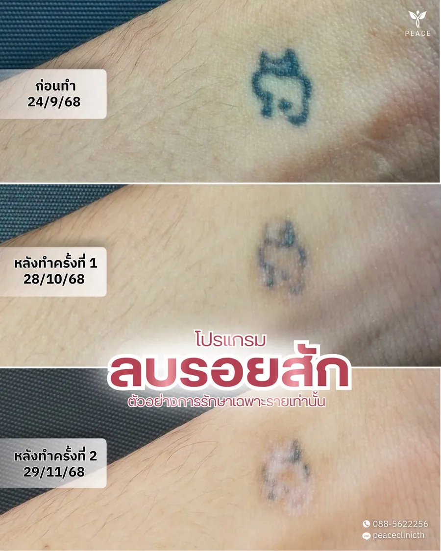 PicoSure · ลบรอยสัก — ก่อนทำ · หลังครั้งที่ 1 · หลังครั้งที่ 2