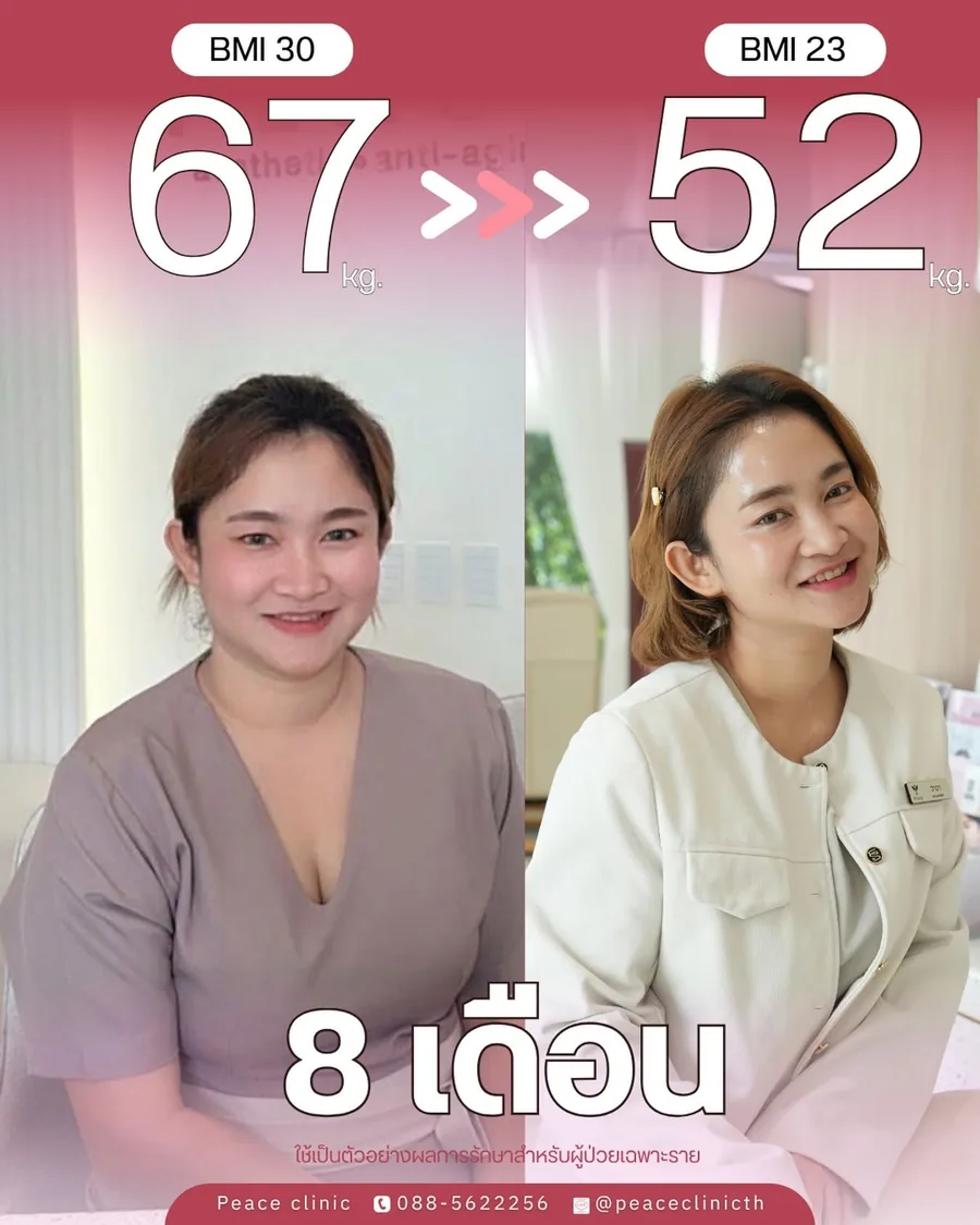 ปักปากกาลดน้ำหนัก · 67 → 52 กก. — BMI 30 → 23 · 8 เดือน