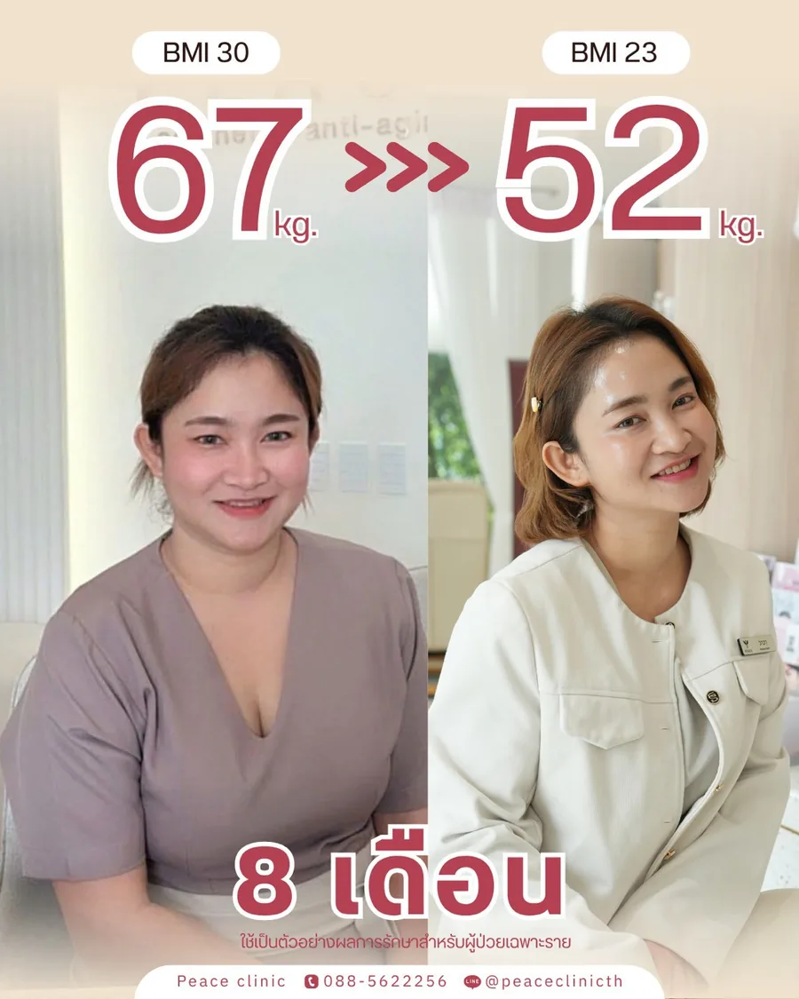 ปักปากกาลดน้ำหนัก · 67 → 52 กก. — BMI 30 → 23 · 8 เดือน