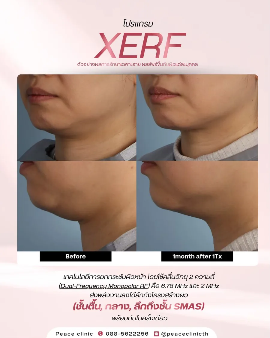 XERF · ยกกระชับ — ใต้คางและลำคอ · หลังทำ 1 เดือน