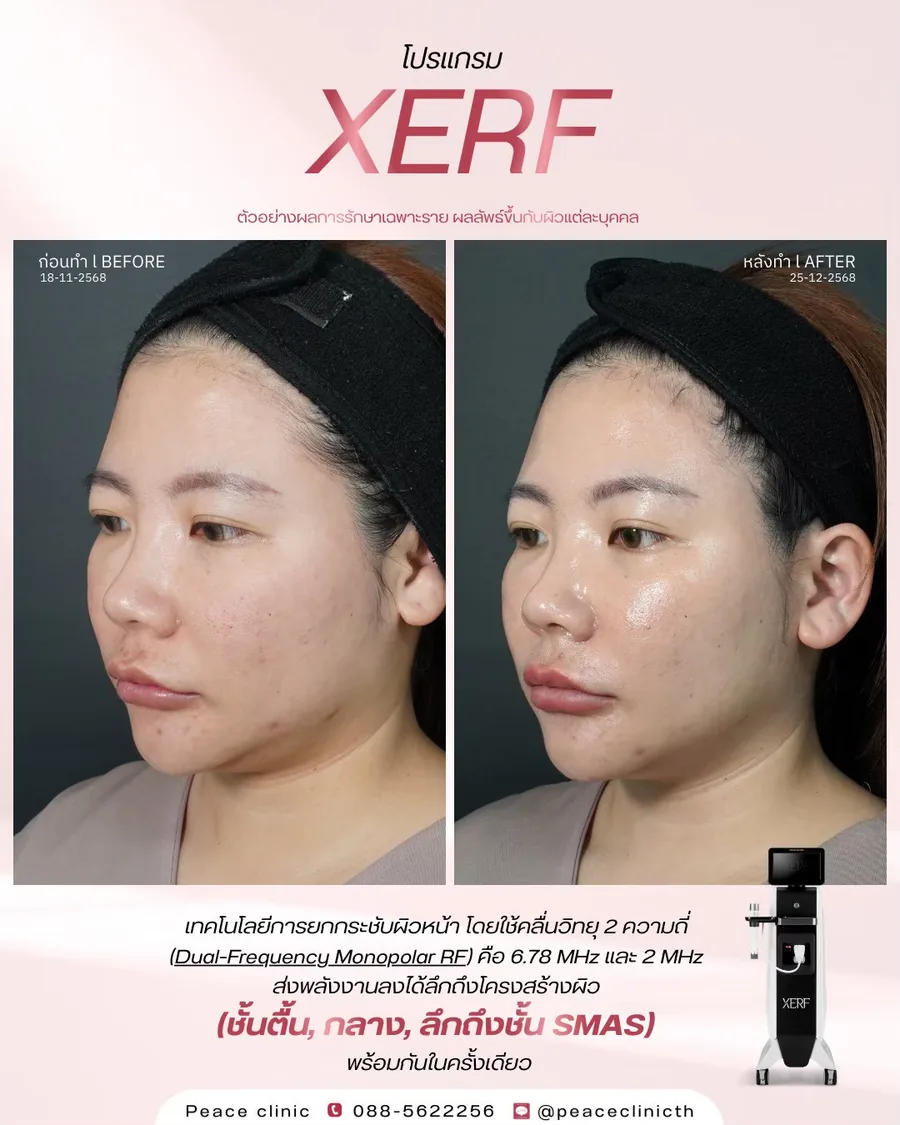XERF · ยกกระชับ — มุมเฉียง · หลังทำ 1 เดือน