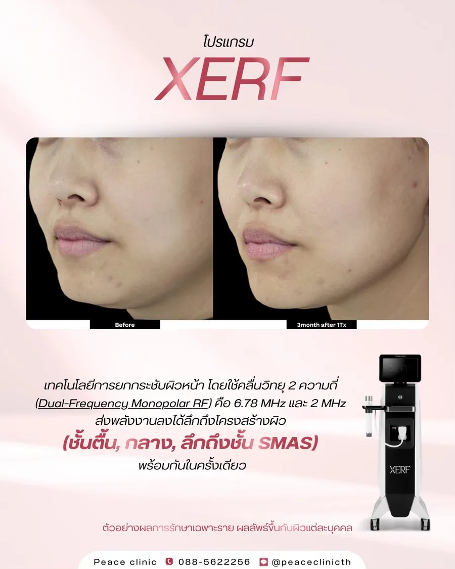 XERF · ยกกระชับ — มุมเฉียง · หลังทำ 1 เดือน
