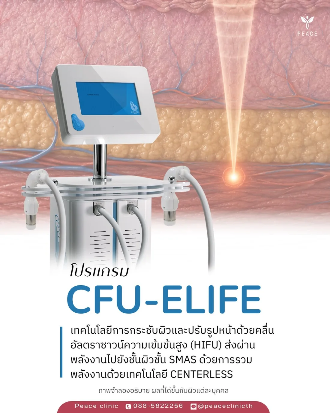 เครื่อง CFU-ÈLIFE จาก Biotec Italia อิตาลี กระชับผิวและปรับรูปหน้า ด้วยคลื่นอัลตราซาวด์ความเข้มข้นสูงแบบ Centerless ที่รวมพลังงาน ไปยังชั้น SMAS มีหัวจับแยกสำหรับงานใบหน้าและงานลำตัว ที่ Peace Clinic แม่สอด