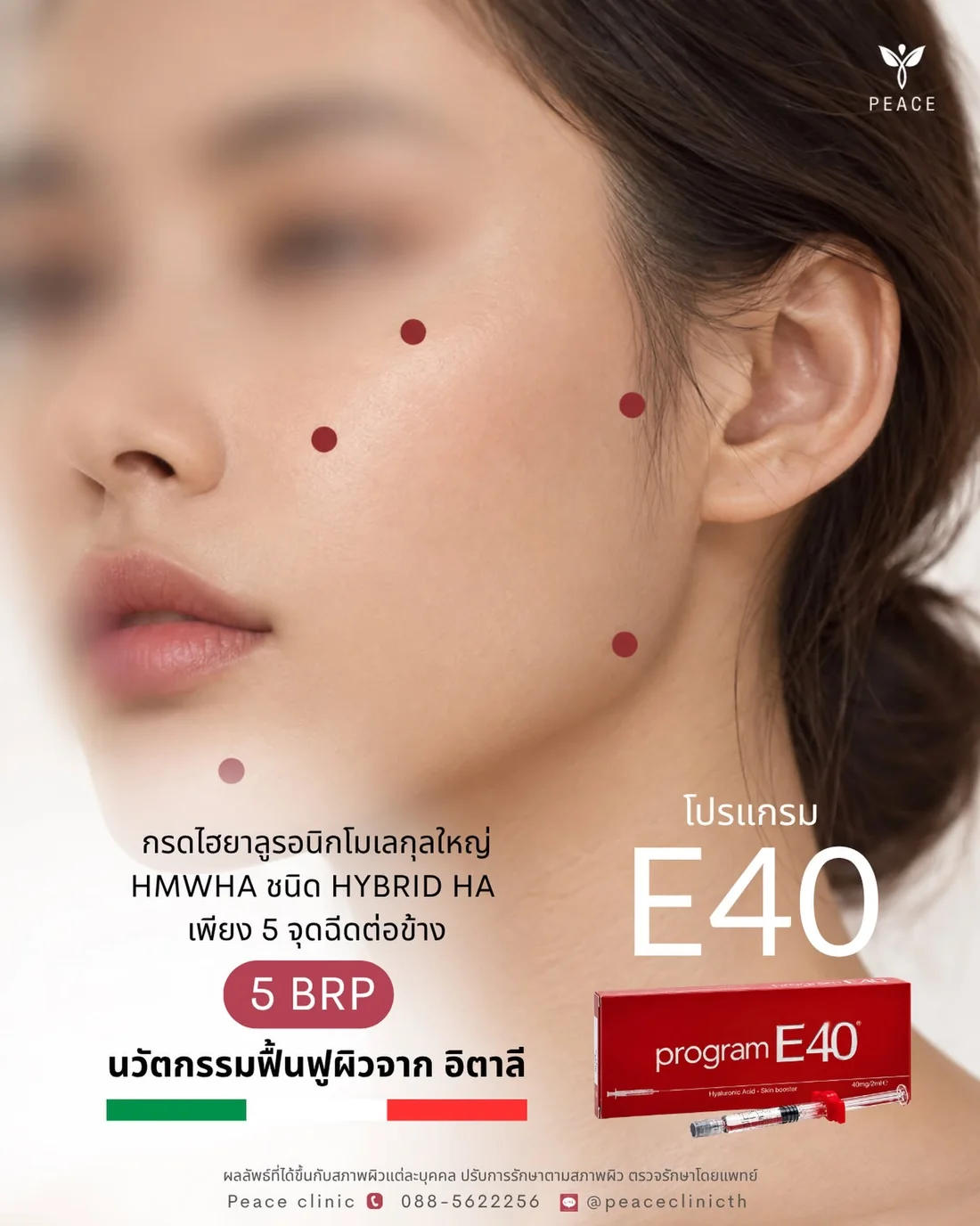โปรแกรม E40 ใช้กรดไฮยาลูรอนิกโมเลกุลใหญ่ HMWHA ชนิด Hybrid HA ฉีดเพียง 5 จุดต่อข้างของใบหน้า นวัตกรรมฟื้นฟูผิวจากอิตาลี