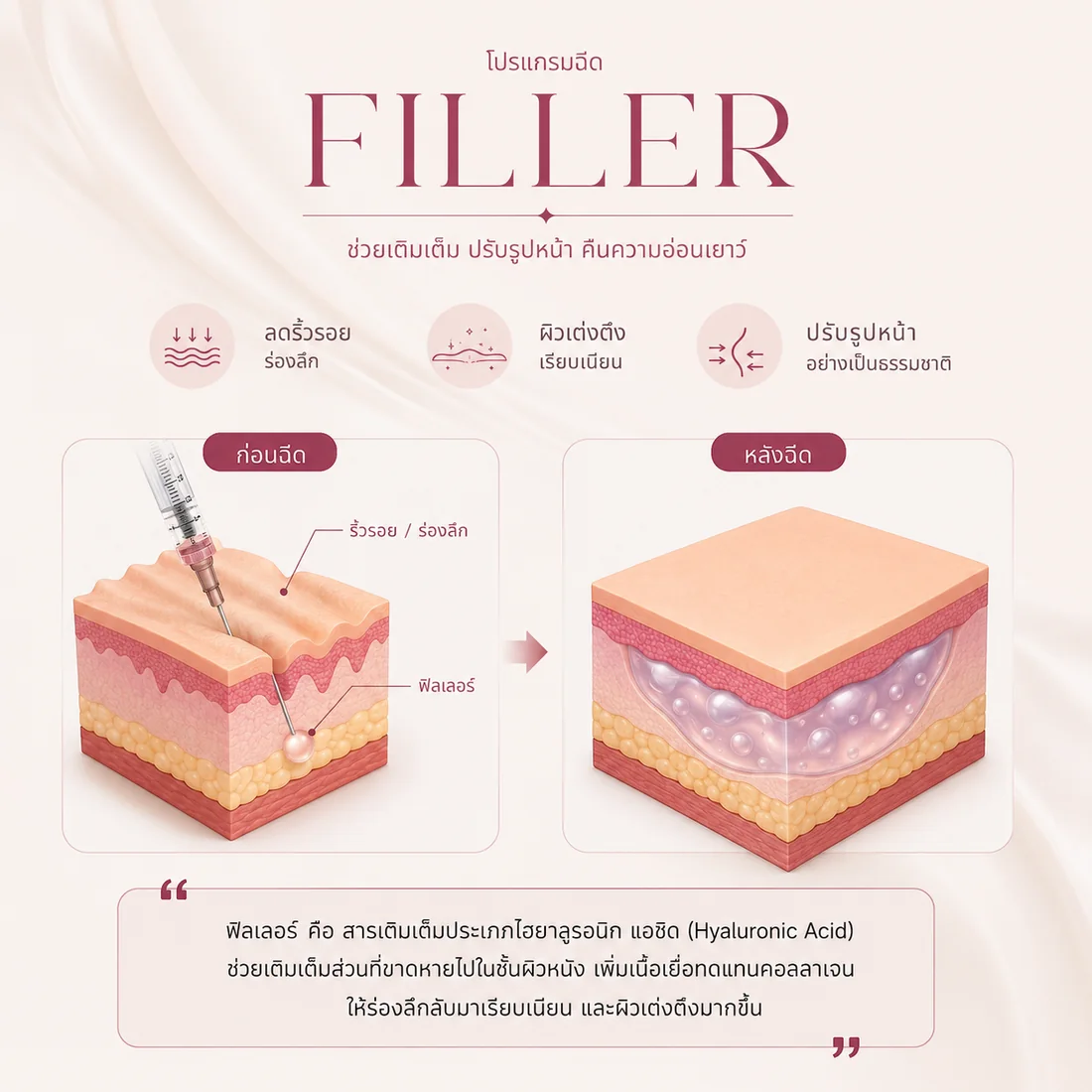 ภาพตัดขวางผิวหนังเทียบก่อนและหลังฉีดฟิลเลอร์ — ก่อนฉีดมีร่องลึกบนผิว เข็มวางฟิลเลอร์ไว้ใต้ร่อง หลังฉีดสารไฮยาลูรอนิกแอซิดกระจายตัว ดันผิวขึ้นจนร่องเรียบและผิวเต่งตึง