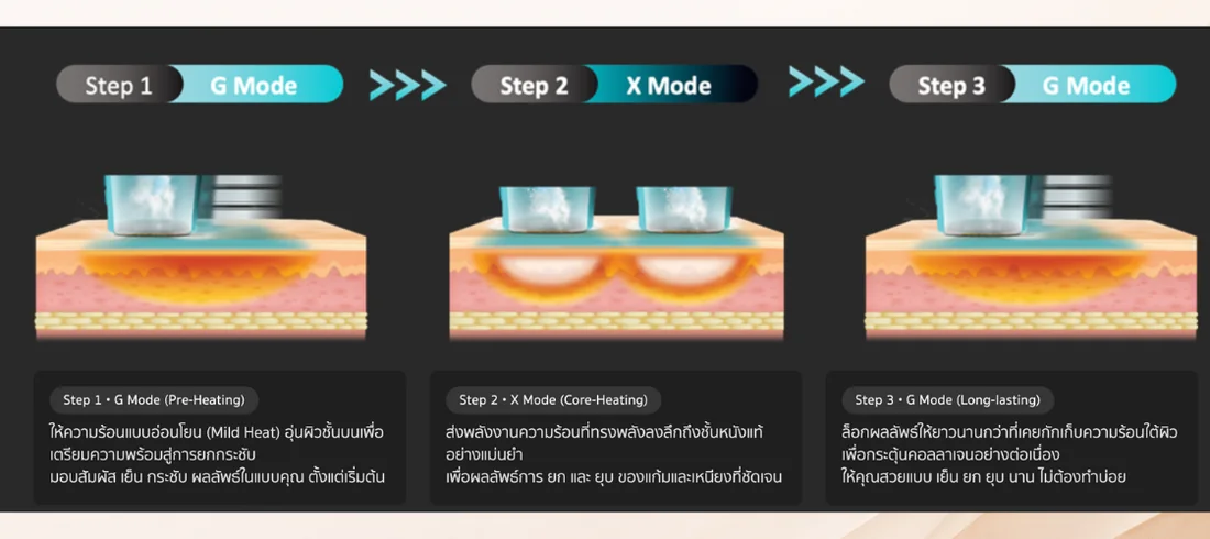 ลำดับการทำงานสามขั้นตอนของเทคโนโลยี GXG Dual Mode ขั้นที่หนึ่งโหมด G อุ่นเตรียมผิว ขั้นที่สองโหมด X ส่งความร้อนลงชั้นหนังแท้ ขั้นที่สามโหมด G ล็อกความร้อนไว้ใต้ผิว