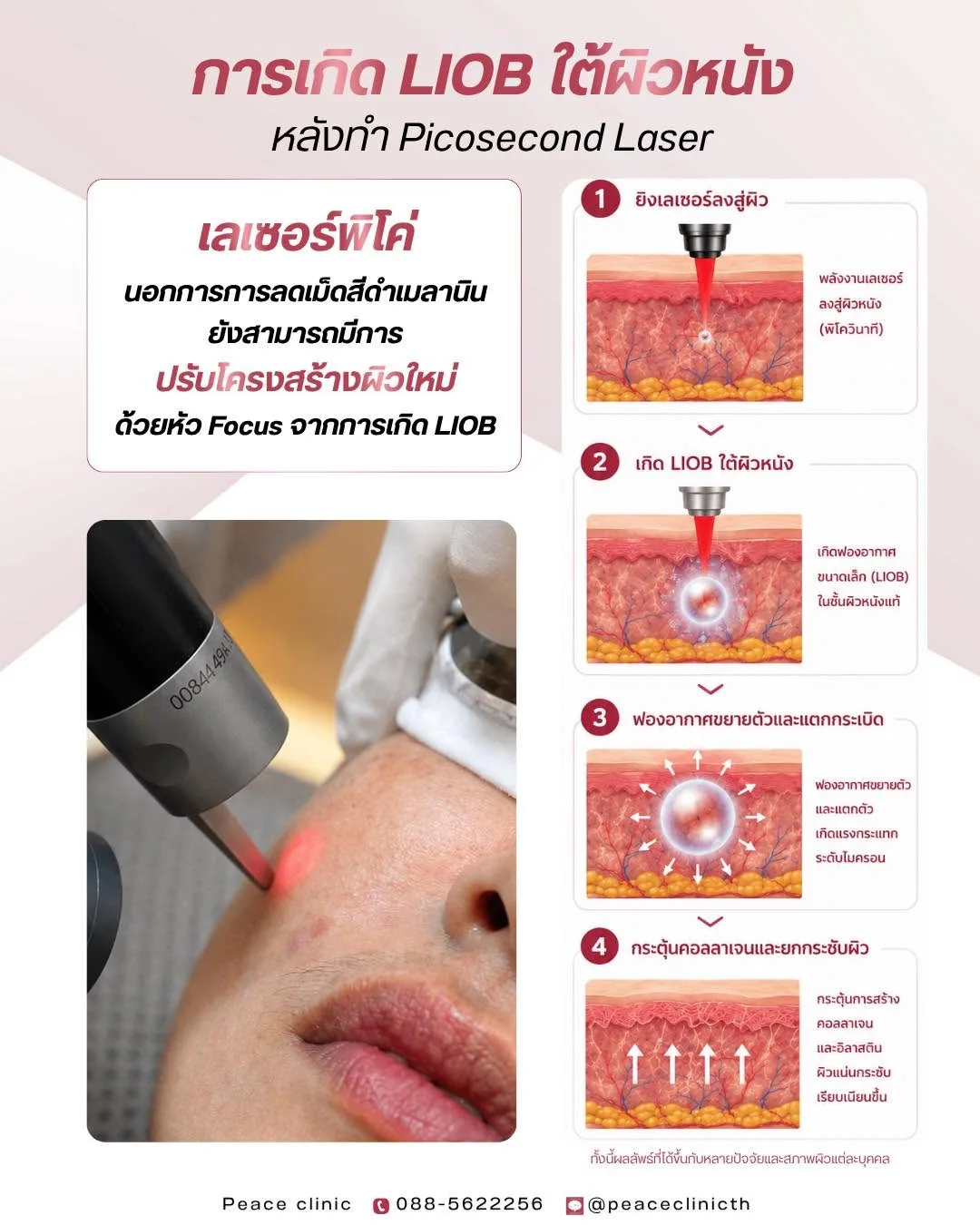 ขั้นตอนการเกิด LIOB ใต้ผิวหนังหลังทำ Picosecond Laser ตั้งแต่ยิงเลเซอร์ เกิดฟองอากาศ แตกตัว จนกระตุ้นคอลลาเจน
