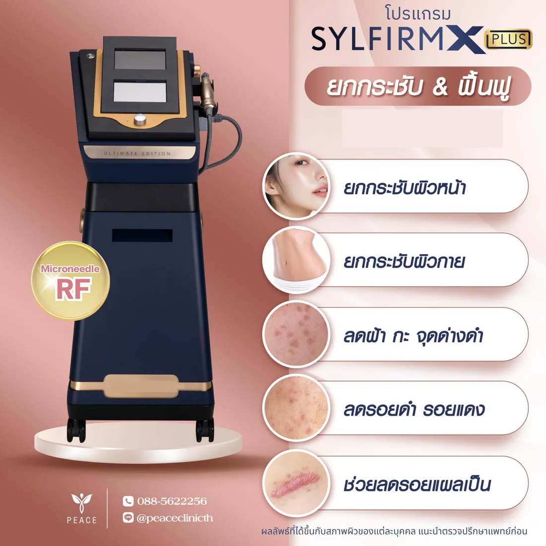 เครื่อง Sylfirm X Plus Ultimate Edition ไมโครนีดเดิล RF ที่ Peace Clinic แม่สอด ใช้ยกกระชับผิวหน้า ยกกระชับผิวกาย ลดฝ้า กระ จุดด่างดำ ลดรอยดำรอยแดงจากสิว และช่วยลดรอยแผลเป็น