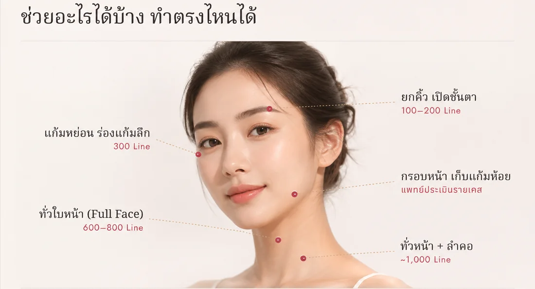 แผนผังใบหน้าแสดงตำแหน่งที่ทำ Ultherapy Prime ได้ ยกคิ้วเปิดชั้นตา 100-200 ไลน์ แก้มหย่อนร่องแก้มลึก 300 ไลน์ ทั่วใบหน้า 600-800 ไลน์ และทั่วหน้ารวมลำคอราว 1,000 ไลน์