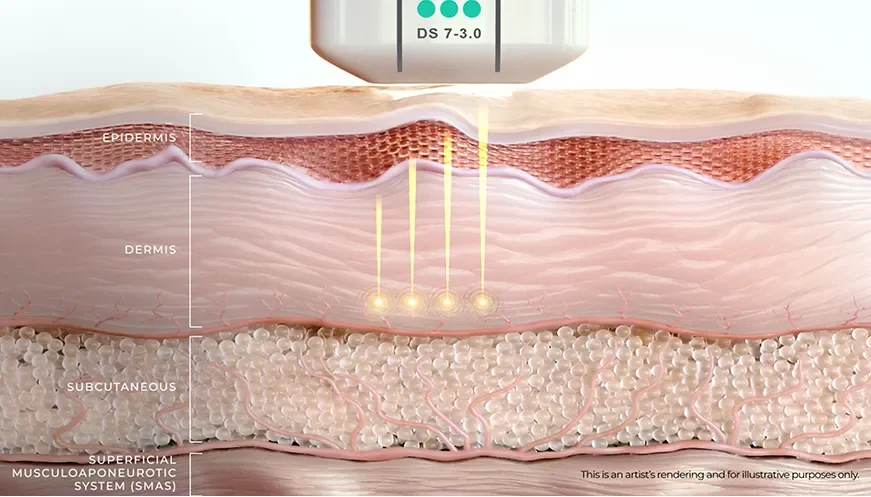 ภาพตัดขวางชั้นผิวขณะทำ Ultherapy PRIME ด้วยหัวทรานสดิวเซอร์ DS 7-3.0 แสดงชั้นหนังกำพร้า หนังแท้ ชั้นไขมันใต้ผิว และชั้น SMAS พร้อมจุดพลังงานความร้อนที่เกิดขึ้นในชั้นหนังแท้โดยผิวชั้นบนไม่ถูกทำลาย