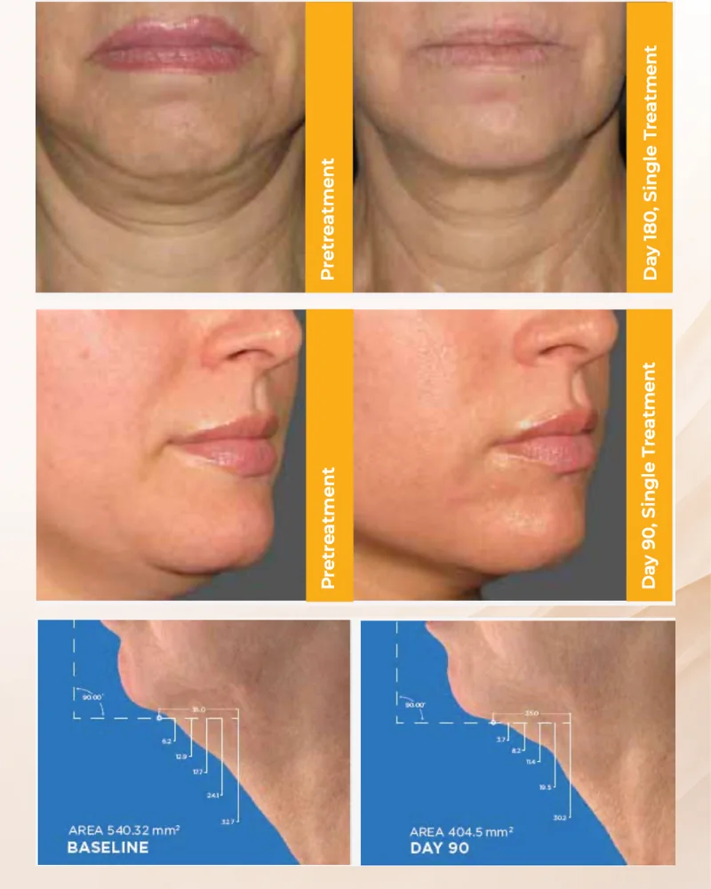 ภาพก่อนและหลังจากการศึกษาทางคลินิก Ultherapy ด้านการยกกระชับลำคอและใต้คาง ที่วันที่ 90 และ 180 หลังทำครั้งเดียว โดย Jeffery Kenkel, MD ที่ UT Southwestern Medical Center