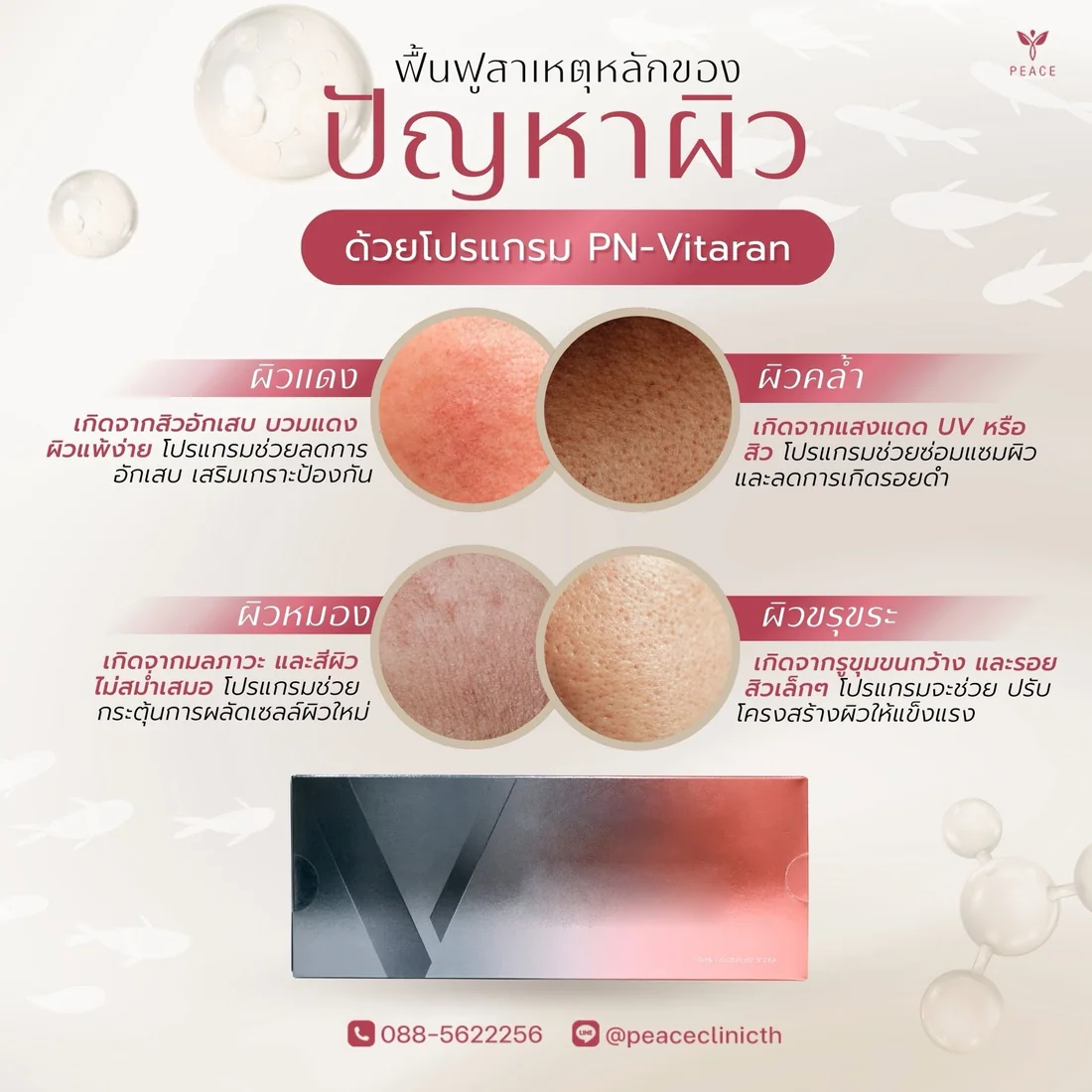 PN-Vitaran ฟื้นฟูปัญหาผิว 4 กลุ่ม — ผิวแดงจากสิวอักเสบ ผิวคล้ำจากแดดและสิว ผิวหมองจากมลภาวะ และผิวขรุขระจากรูขุมขนกว้าง