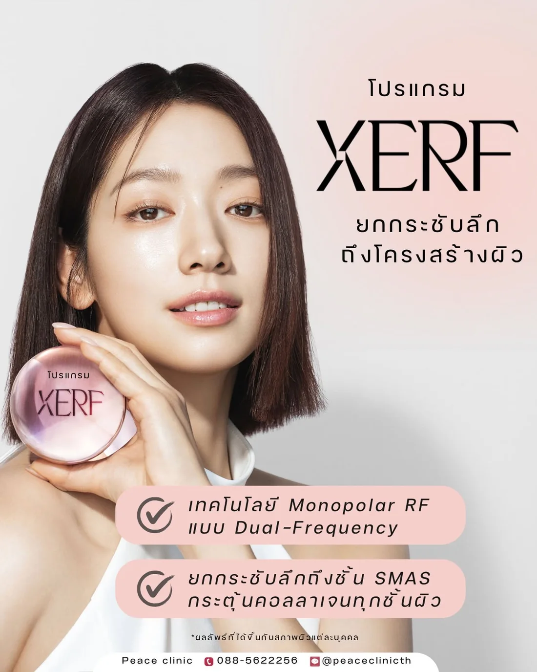 โปรแกรม XERF เทคโนโลยี Monopolar RF แบบ Dual-Frequency ยกกระชับลึกถึงชั้น SMAS ที่ Peace Clinic แม่สอด