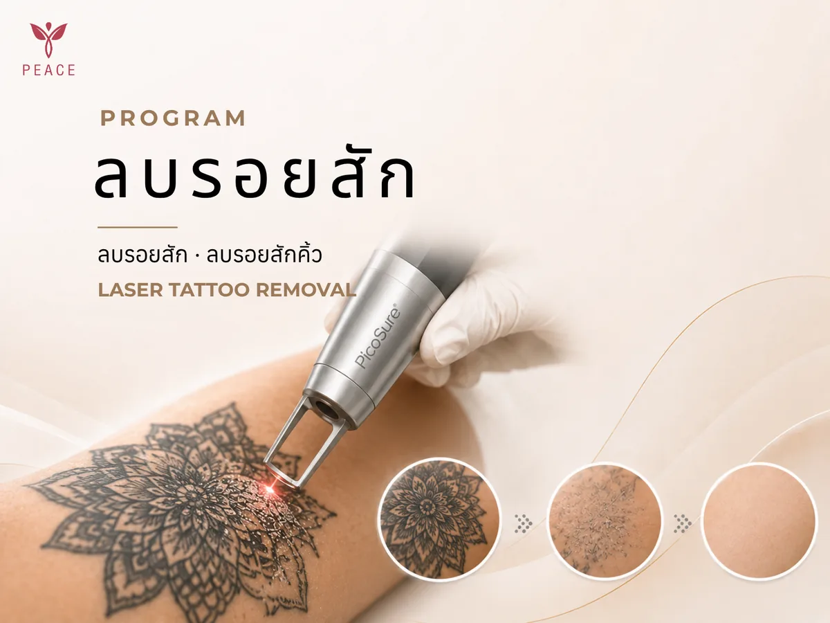 ลบรอยสัก ด้วย PicoSure ที่ Peace Clinic แม่สอด