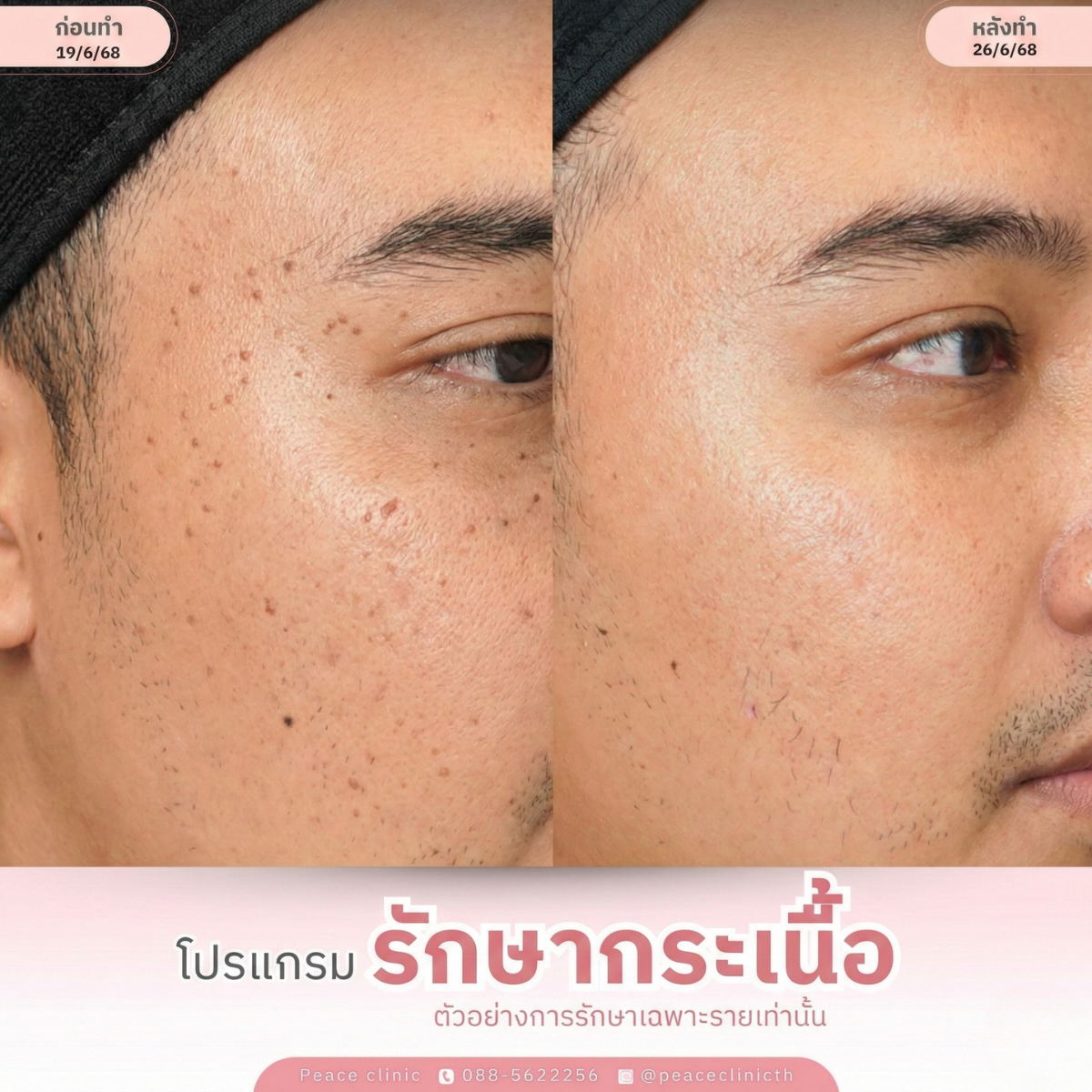 peace clinic โปรแกรม Fractional CO2 Laser_review(5)