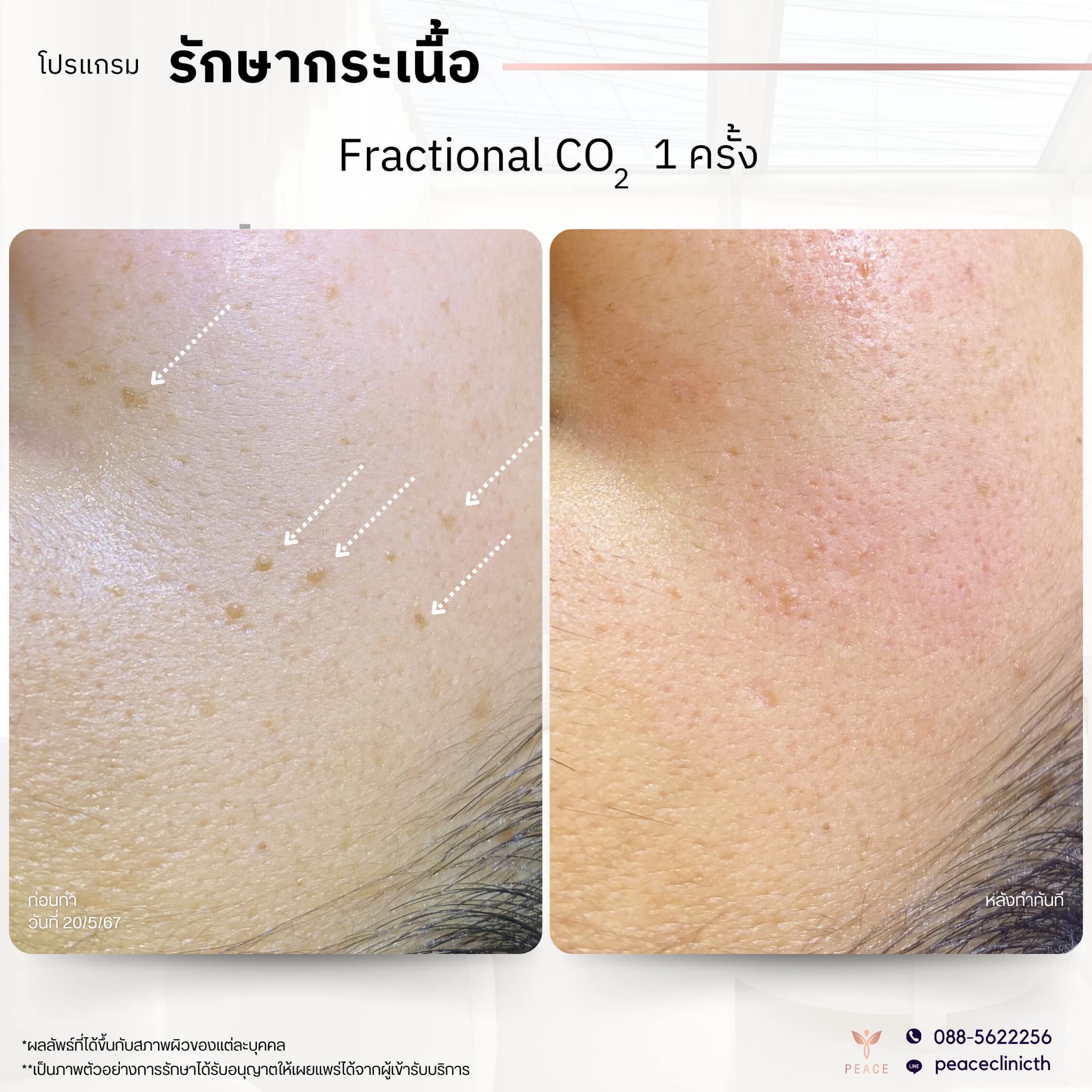 peace clinic โปรแกรม Fractional CO2 Laser_review(6)
