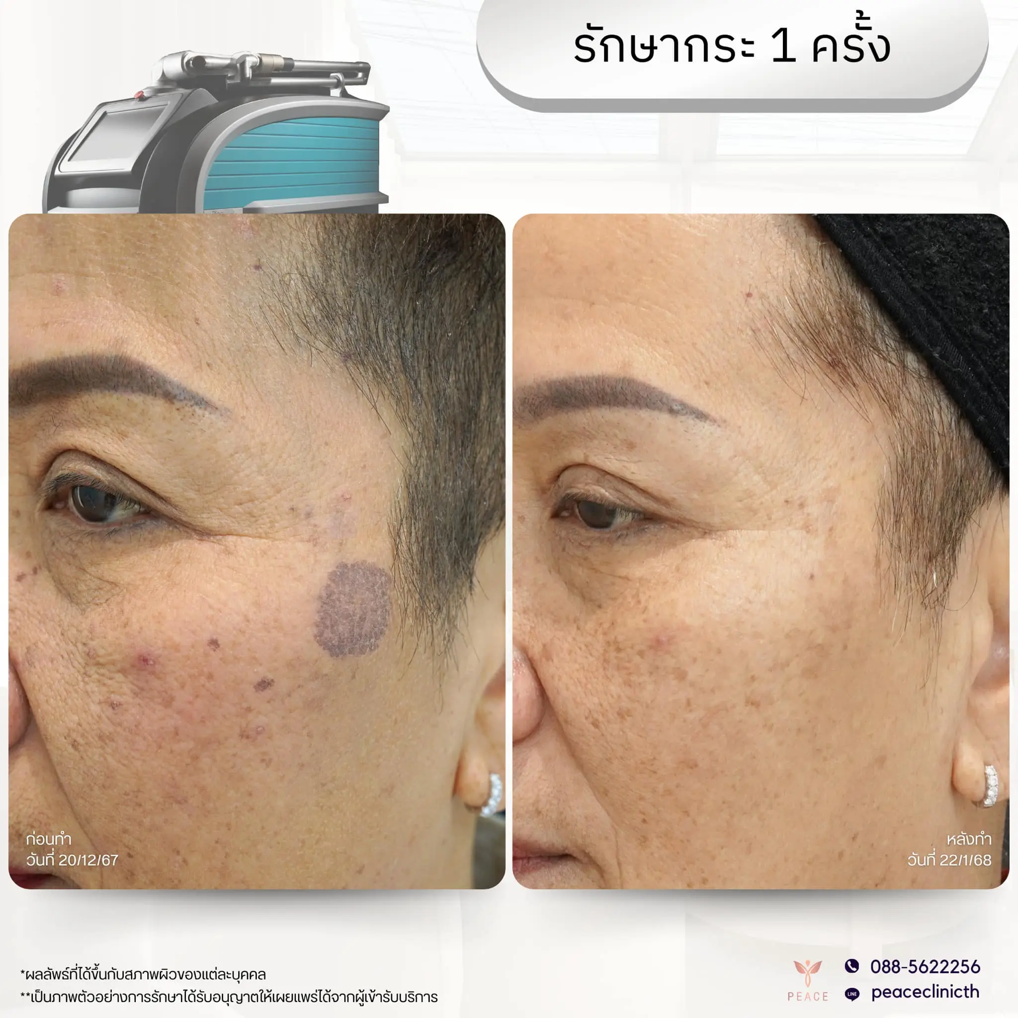 review_โปรแกรม PicoSure_2