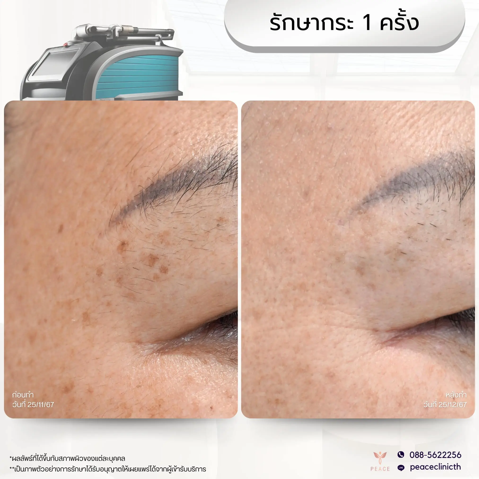 review_โปรแกรม PicoSure_3