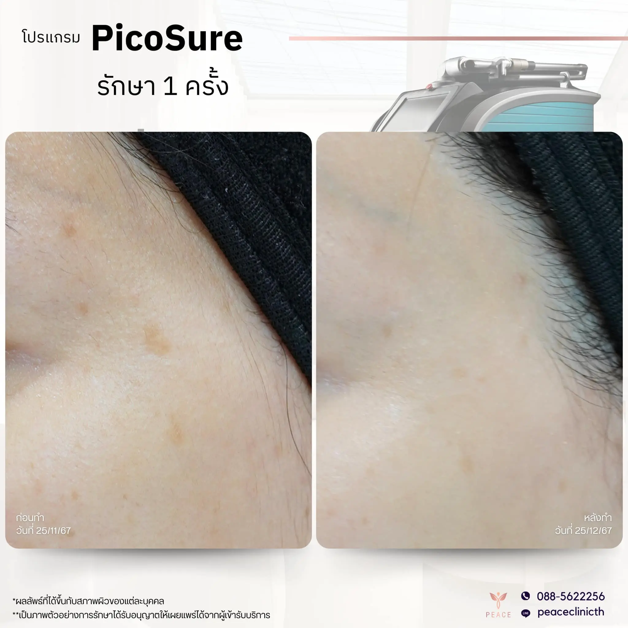 review_โปรแกรม PicoSure_4