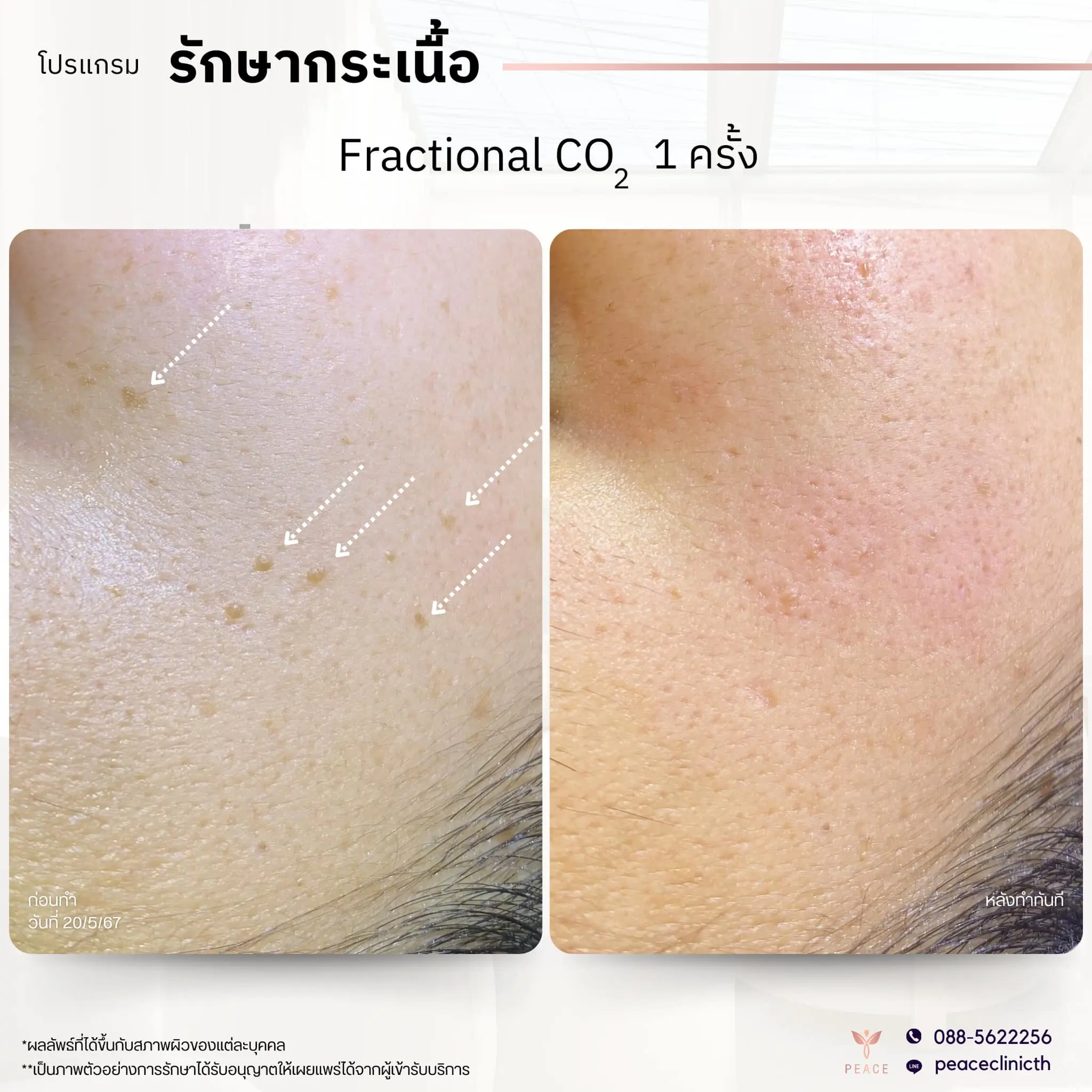 review_โปรแกรม PicoSure_5