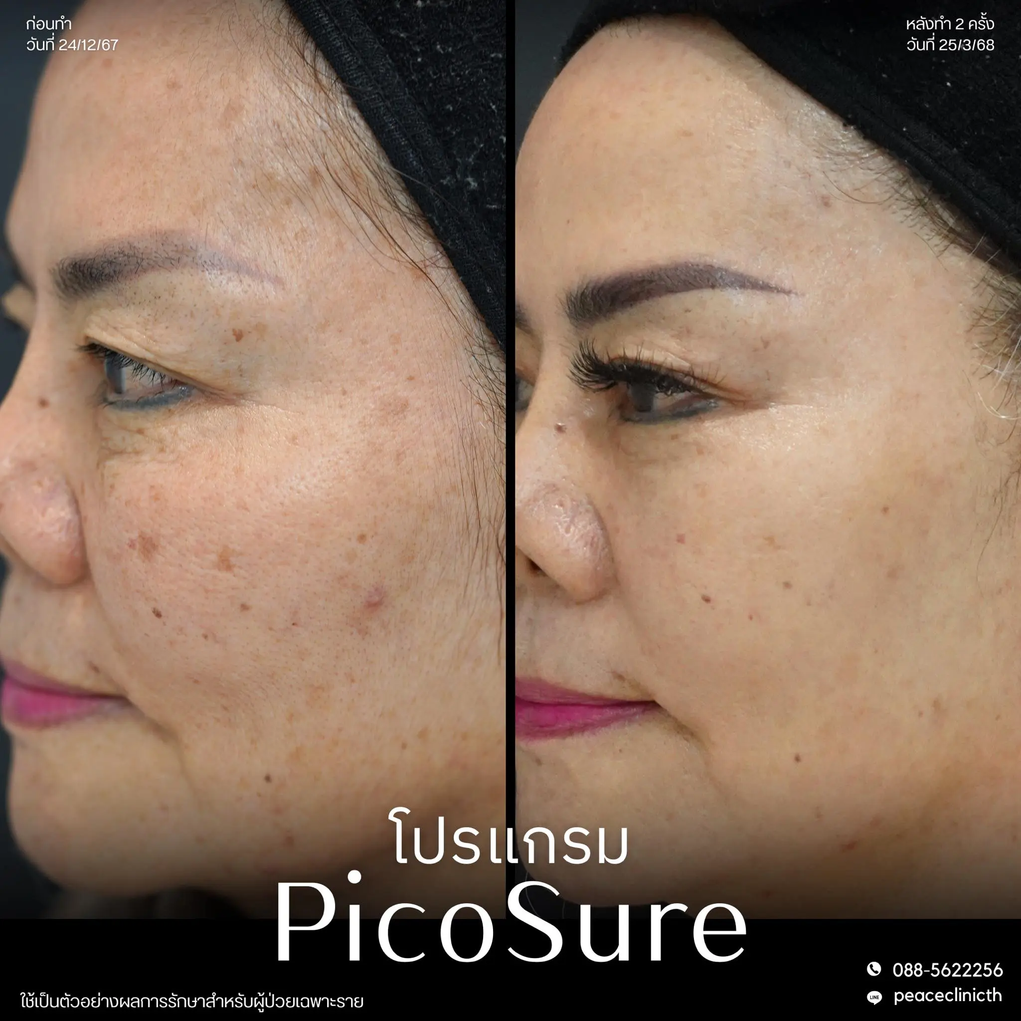 review_โปรแกรม PicoSure_7