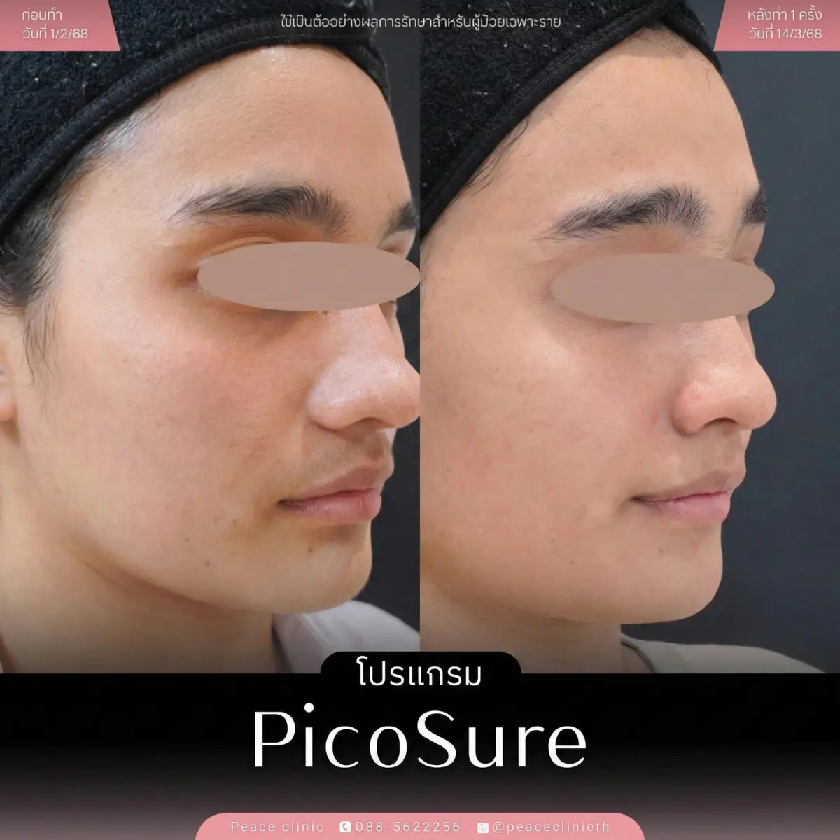 review_โปรแกรม PicoSure_8